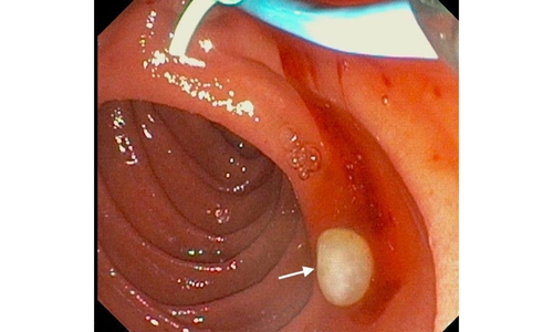 Die endoskopische Behandlung ERCP mit der gewonnenen Larve (Pfeil).