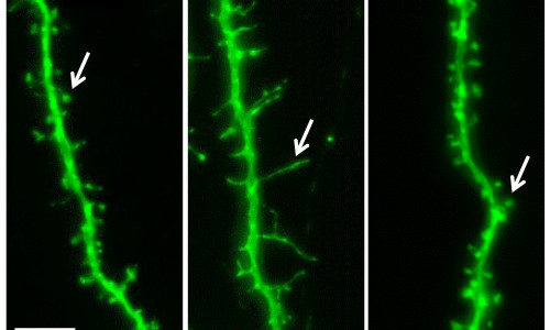  

Nervenzellfortsätze (Dendriten) einer Kontroll-Maus, des FXS Mausmodells sowie des FXS Mausmodells, in dem die zu geringe Konzentration von PFN1 durch Manipulation der Genexpression erhöht wurde (Überexpression von PFN1). Die Pfeile deuten auf einzelne Synapsen hin. Quelle: „TU Braunschweig“