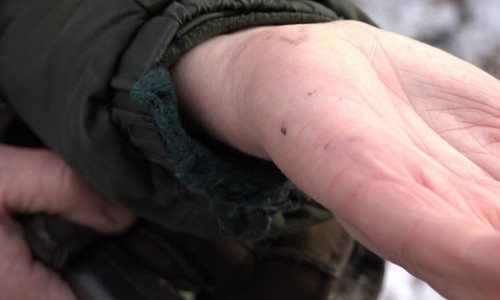 Die vom Marderhund angegriffene Ursula Reiff zeigt eine ihrer Bisswunden. Fotos und Video: aktuell24