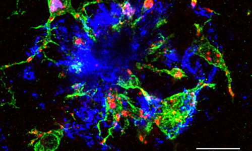 Blick in das Gehirn einer „Alzheimer-Maus“: Mikrogliazellen (grün) umranden einen Amyloid-β Plaque (blau), eine für die Alzheimer-Krankheit typische Eiweiß-Ablagerung im Gehirn der Tiere. Aus den eher rundlichen Zellkörpern der Mikrogliazellen entspringen dünne Fortsätze, die in die Struktur des Amyloid-β Plaques reichen. Zusätzlich sind in Rot die Lysosomen in den Mikrogliazellen angefärbt. Diese geben Aufschluss darüber, dass sich die Mikrogliazellen in einem aktivierten Zustand befinden (Maßstab 10µm). 
