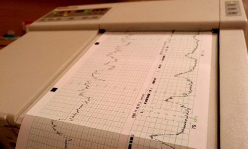 Kardiotokografie im Krankenhaus (Archiv)