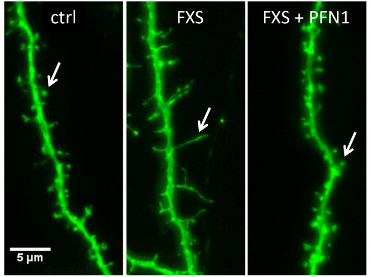  

Nervenzellfortsätze (Dendriten) einer Kontroll-Maus, des FXS Mausmodells sowie des FXS Mausmodells, in dem die zu geringe Konzentration von PFN1 durch Manipulation der Genexpression erhöht wurde (Überexpression von PFN1). Die Pfeile deuten auf einzelne Synapsen hin. Quelle: „TU Braunschweig“