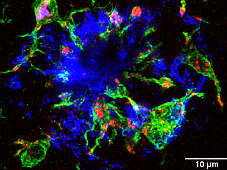 Blick in das Gehirn einer „Alzheimer-Maus“: Mikrogliazellen (grün) umranden einen Amyloid-β Plaque (blau), eine für die Alzheimer-Krankheit typische Eiweiß-Ablagerung im Gehirn der Tiere. Aus den eher rundlichen Zellkörpern der Mikrogliazellen entspringen dünne Fortsätze, die in die Struktur des Amyloid-β Plaques reichen. Zusätzlich sind in Rot die Lysosomen in den Mikrogliazellen angefärbt. Diese geben Aufschluss darüber, dass sich die Mikrogliazellen in einem aktivierten Zustand befinden (Maßstab 10µm). 